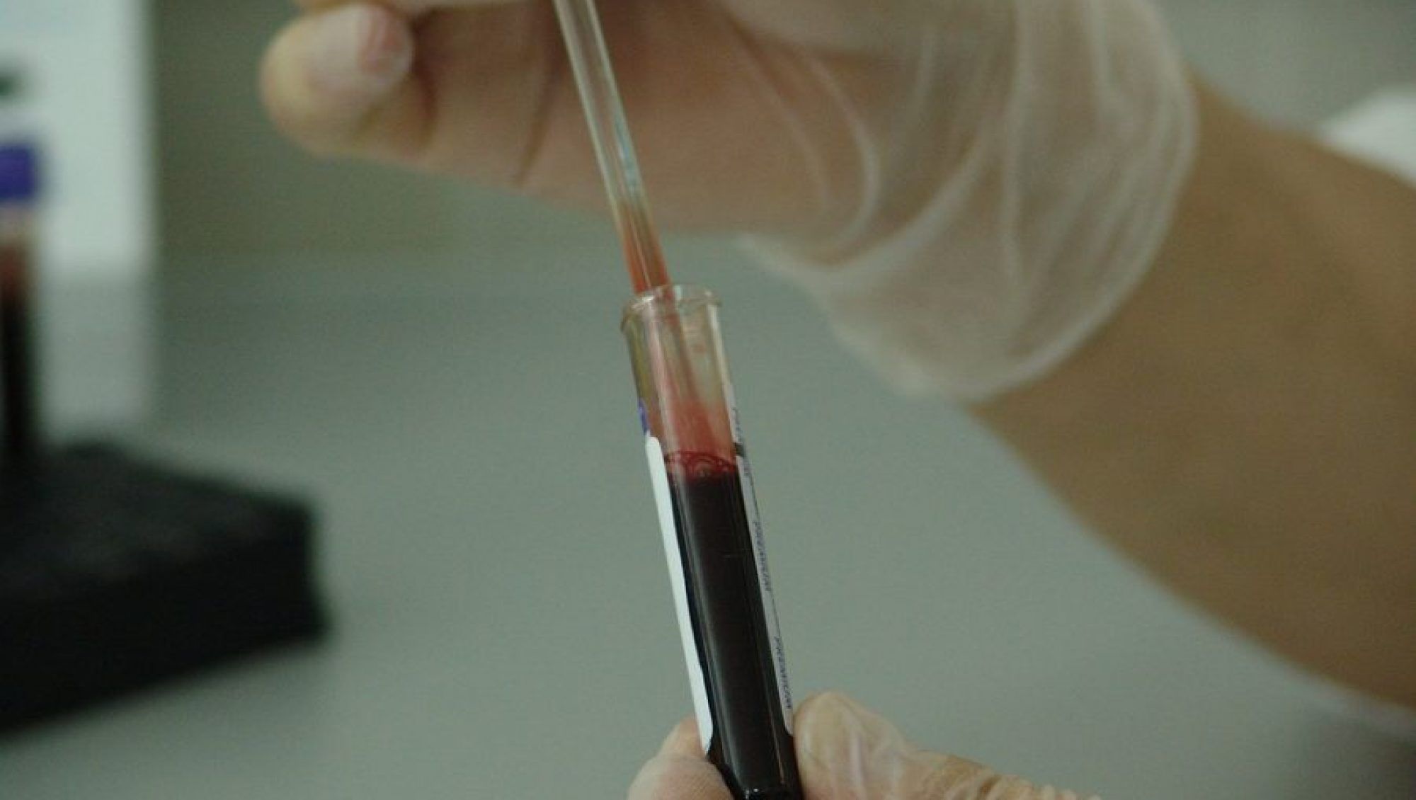 Evaluación endocrinológica-análisis de sangre-IMOBariatrica Categoría endocrinología - Evaluación endocrinológica-análisis de sangre-IMOBariatrica