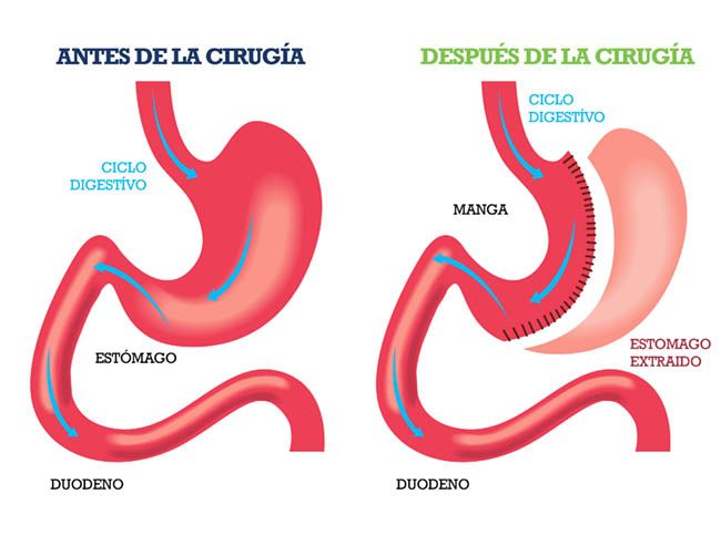 Manga gástrica - cirugía - IMOBariátrica Manga gástrica - cirugía - IMOBariátrica