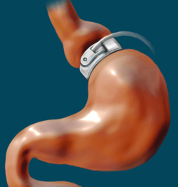 Banda gástrica ajustable – Ventajas y desventajas - IMObariatrica Banda gástrica ajustable – Ventajas y desventajas - IMObariatrica