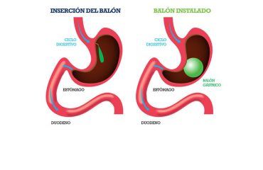 Balón-Intragástrico-CirugíaBariatrica-IMOBariatrica (Grande) Balón-Intragástrico-CirugíaBariatrica-IMOBariatrica (Grande)