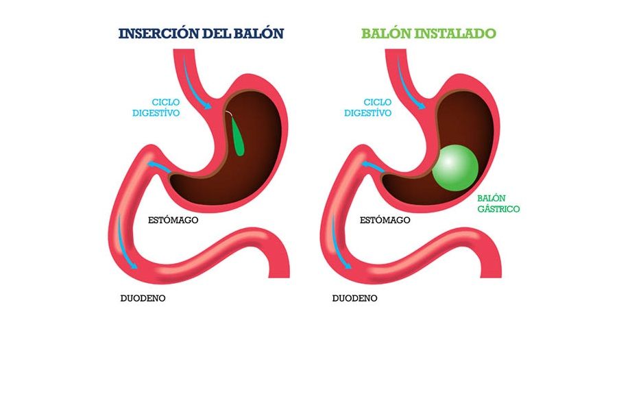 Balón-Intragástrico-CirugíaBariatrica-IMOBariatrica (Grande) Balón-Intragástrico-CirugíaBariatrica-IMOBariatrica (Grande)