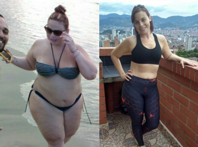 Bariátrica - Cirugías - Testimonios -IMOBariatrica- Manuela Tovar - cirugía metabólica