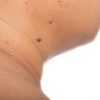 Categoría: medicina bariátrica - Trastornos dermatológicos Obesidad-Dermatología-IMOBariatrica