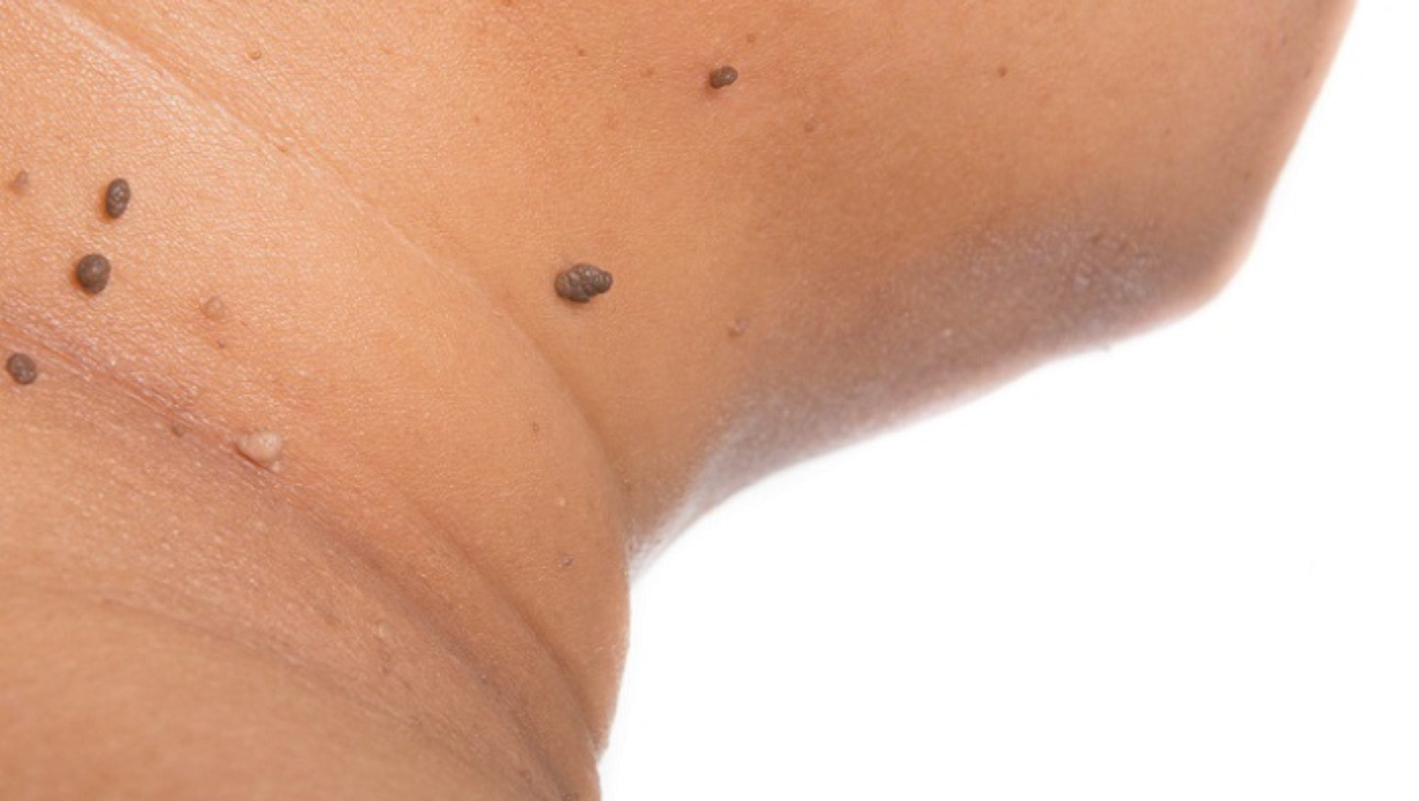 Categoría: medicina bariátrica - Trastornos dermatológicos Obesidad-Dermatología-IMOBariatrica