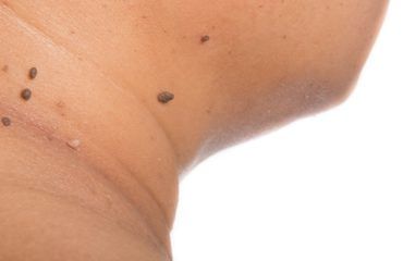 Categoría: medicina bariátrica - Trastornos dermatológicos Obesidad-Dermatología-IMOBariatrica