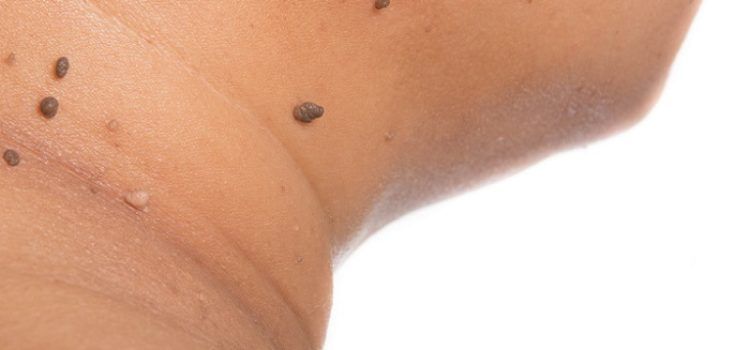 Categoría: medicina bariátrica - Trastornos dermatológicos Obesidad-Dermatología-IMOBariatrica