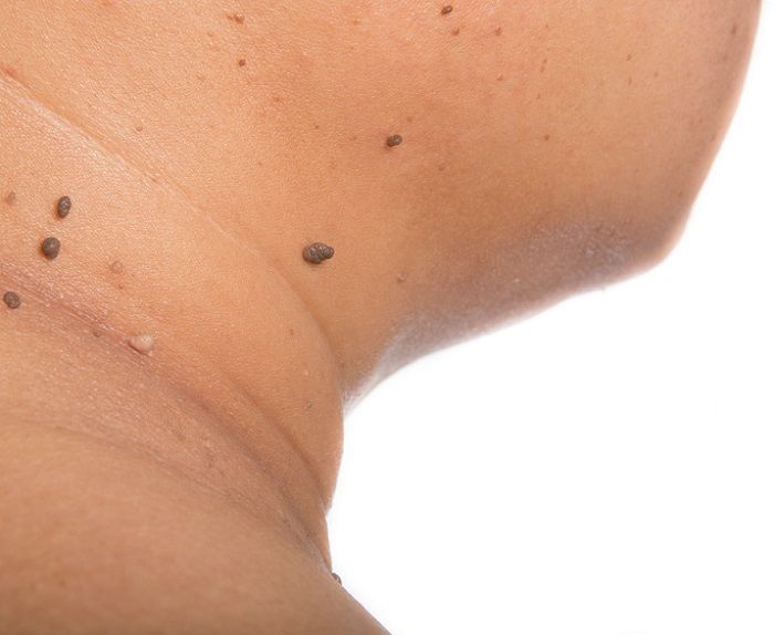 Categoría: medicina bariátrica - Trastornos dermatológicos Obesidad-Dermatología-IMOBariatrica