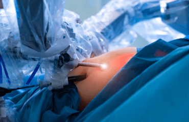 Cicatrices quirúrgicas – laparoscopia – IMOBariatrica Cicatrices quirúrgicas - laparoscopia - IMOBariatrica
