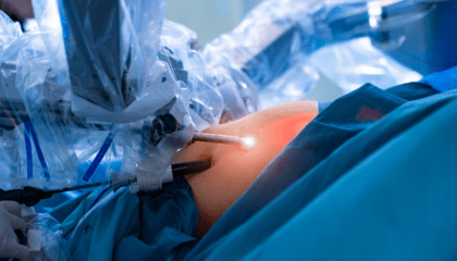 Cicatrices quirúrgicas - laparoscopia - IMOBariatrica